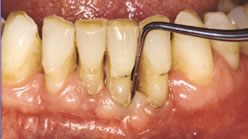 Gum Health