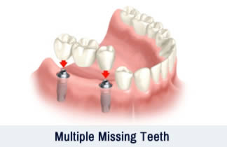 Multiple Missing Teeth