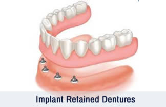 Implant Retained Dentures