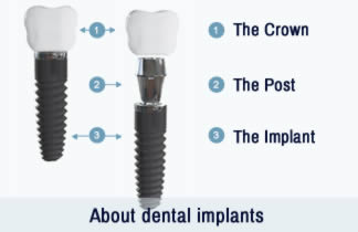 About Dental Implants